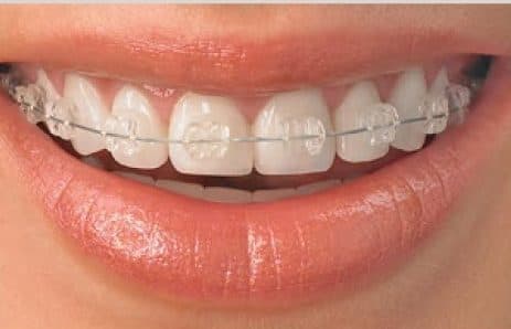 Ceramic Braces