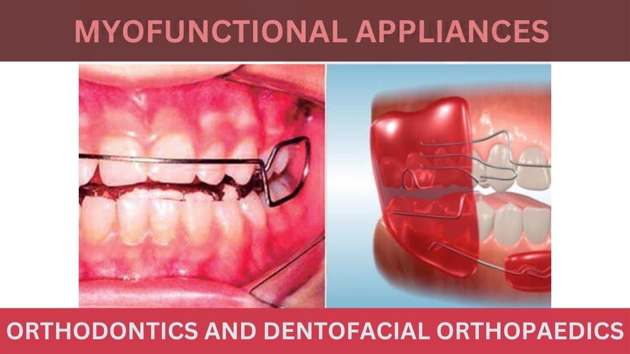 Myofunctional Appliances